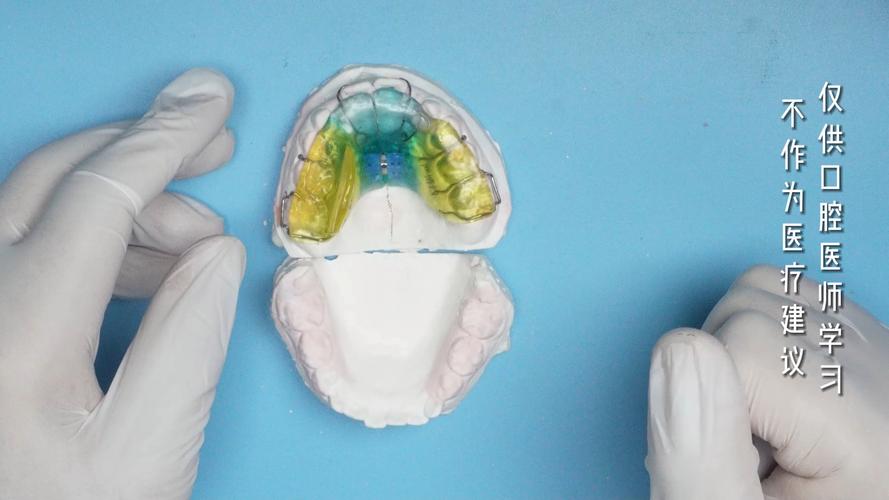 牙齿矫正扩弓是什么？扩弓矫正的原理与作用？-图3