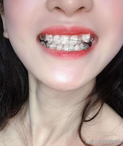 成年了牙齿能矫正吗-图3 成年了牙齿能矫正吗-图3