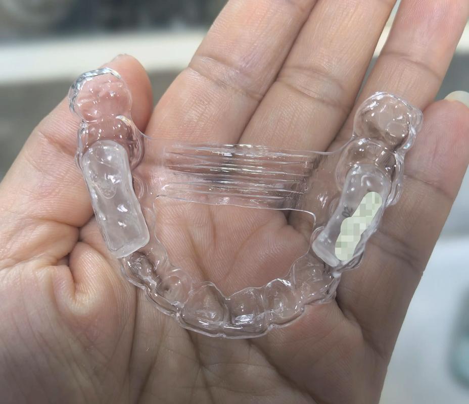 牙套矫正牙齿真的有效吗？效果和安全性如何？-图1