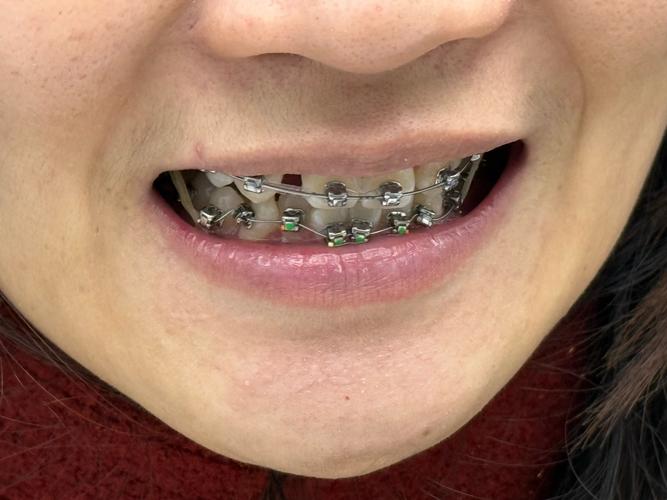 矫正牙齿被拉开间隙-图1