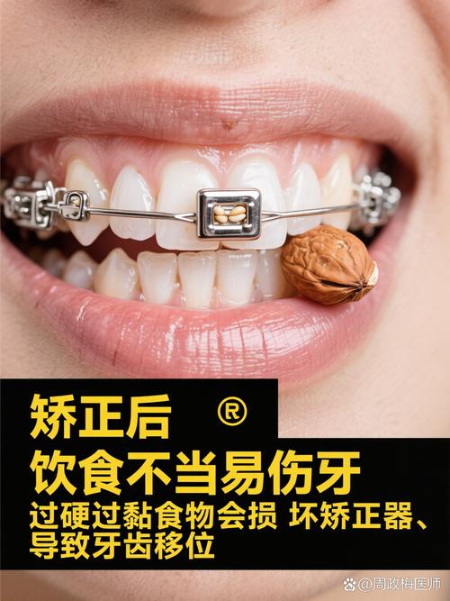 矫正牙齿期间，到底能不能正常吃东西？-图2