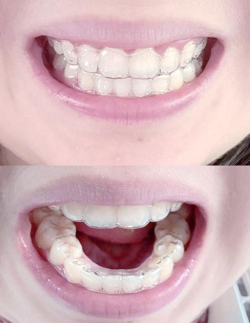 矫正过后的牙齿图片-图1 矫正过后的牙齿图片-图1