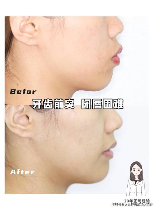 矫正牙齿真的会改变嘴型吗？具体会有哪些变化？-图1