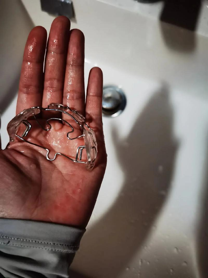 牙齿矫正后又反弹了-图1