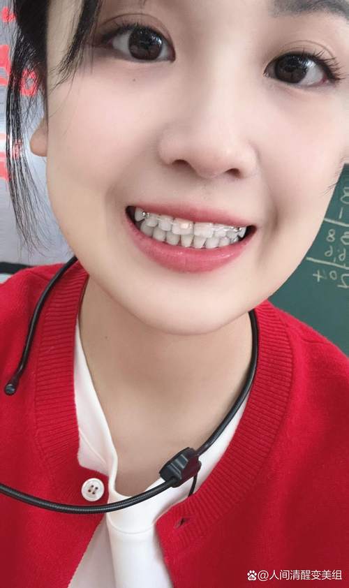 矫正完牙齿戴保持器-图1