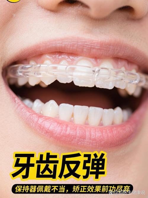 矫正完牙齿戴保持器-图2