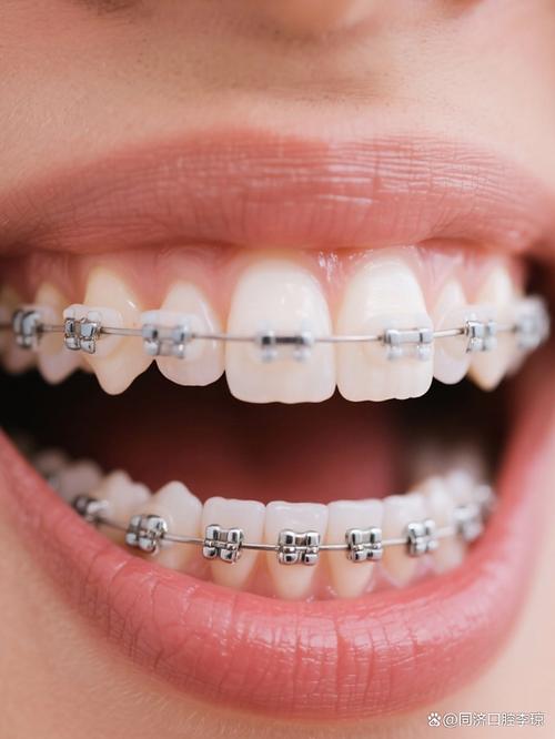 有虫牙还能做牙齿矫正吗?-图2 有虫牙还能做牙齿矫正吗?-图2