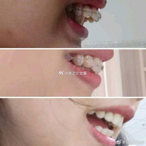 牙齿矫正会导致牙槽骨增生吗？原因和应对方法是什么？-图1