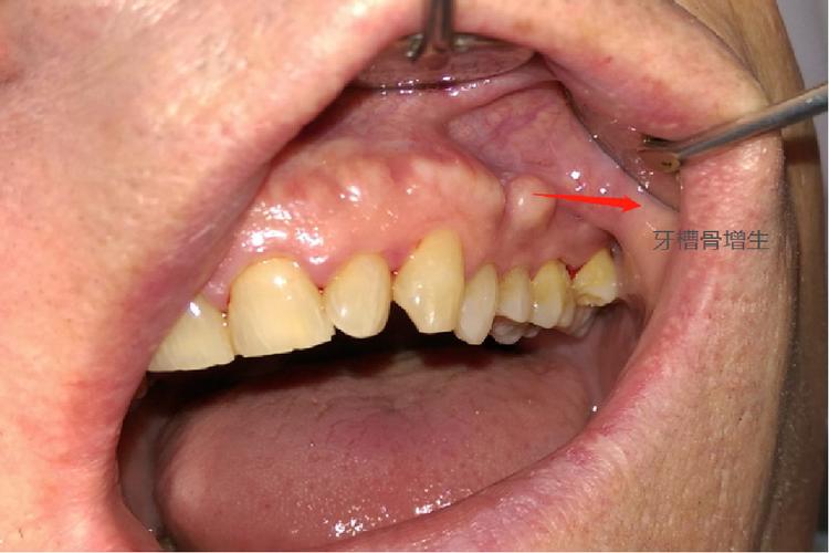 牙齿矫正会导致牙槽骨增生吗？原因和应对方法是什么？-图3