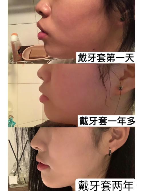 牙齿矫正前后对照图，为何变化效果如此显著？-图1