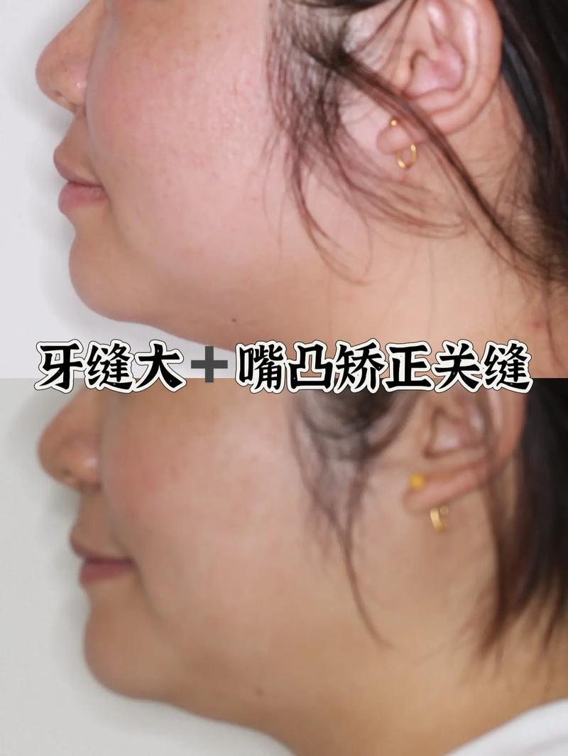 牙齿牙缝大能矫正吗-图2