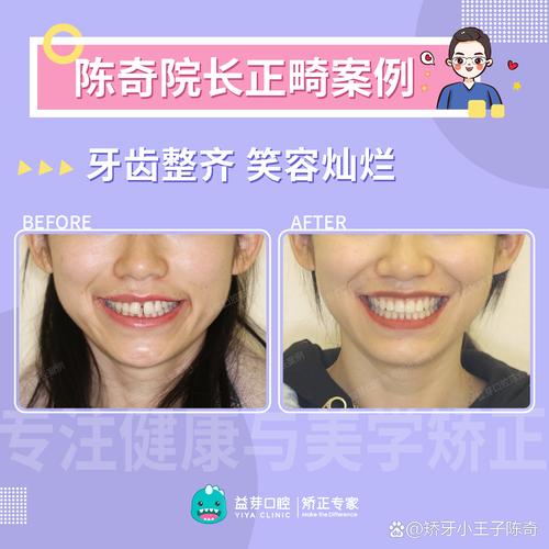 牙齿覆咬合矫正难度大吗？效果如何？-图2