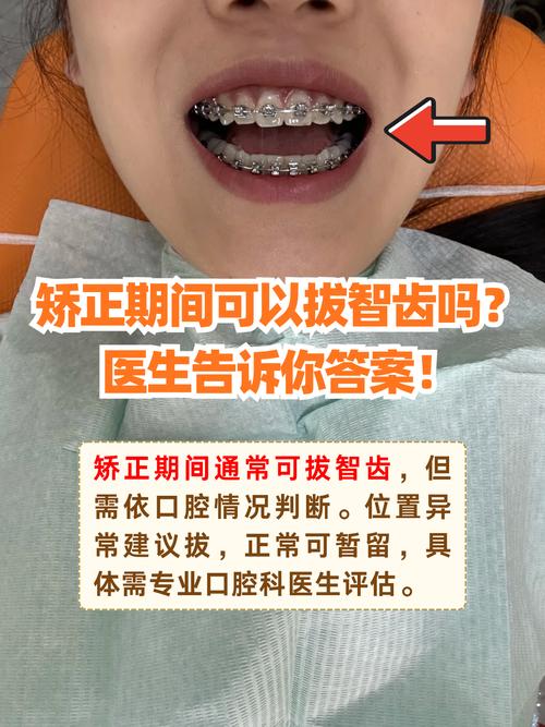 牙齿矫正前必须拔牙吗？这些情况决定要不要-图2