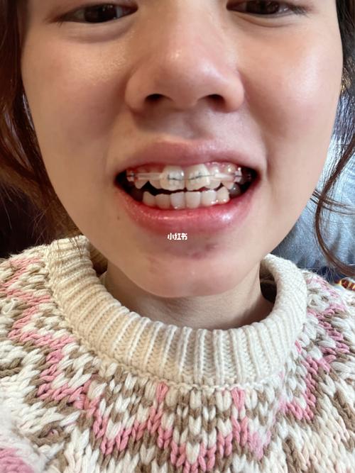 陶瓷自锁矫正牙齿图-图2