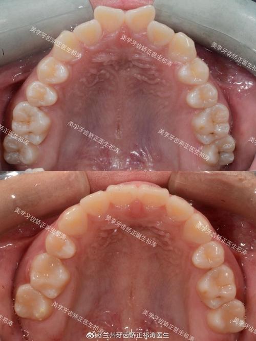 成都隐适美矫正效果如何？体验怎么样？-图2