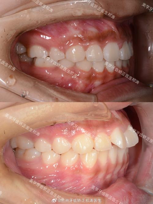 成都隐适美矫正效果如何？体验怎么样？-图1