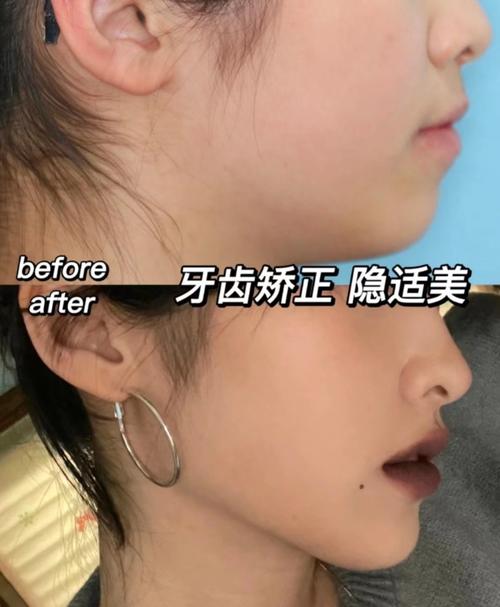 成都隐适美矫正效果如何？体验怎么样？-图3