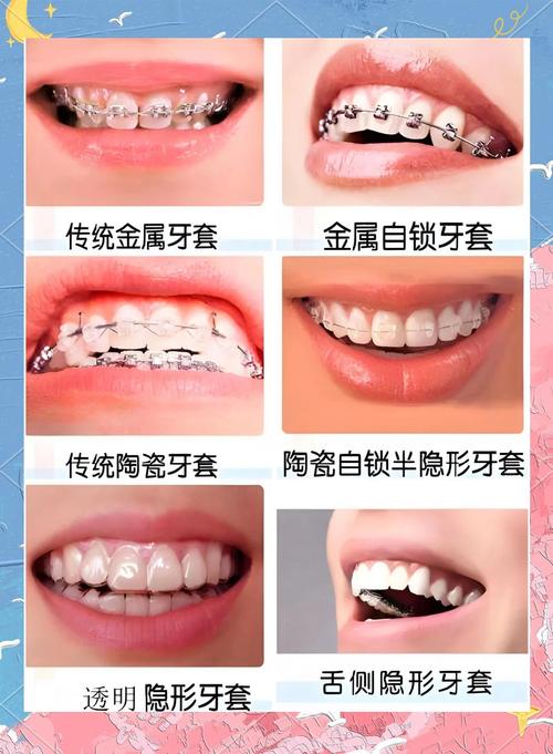 牙齿矫正自锁是什么？-图1