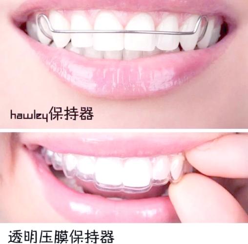 矫正牙齿后为何必须戴保持器？不戴会反弹吗？-图2