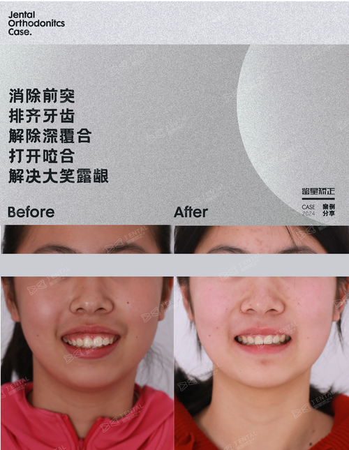 矫正牙齿会导致牙龈外露吗？-图1