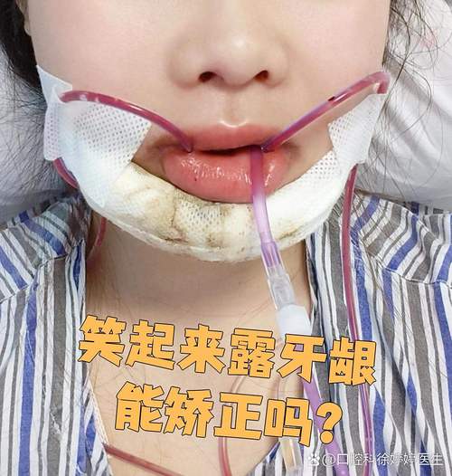 矫正牙齿会导致牙龈外露吗？-图2