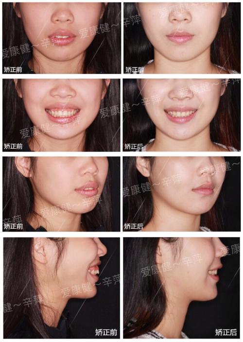 矫正牙齿会导致牙龈外露吗？-图3
