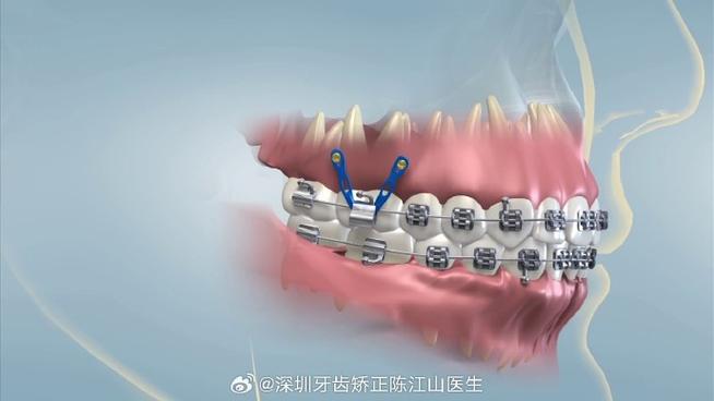 矫正牙齿打麻药疼不疼?-图2 矫正牙齿打麻药疼不疼?-图2