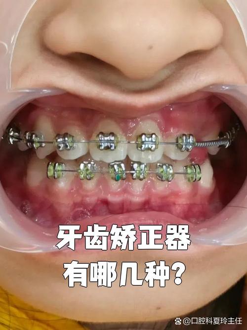网上矫正牙齿有用吗？效果到底靠谱吗？-图2