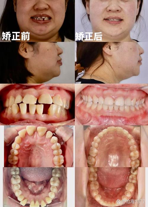 矫正牙齿牙缝合不上-图2