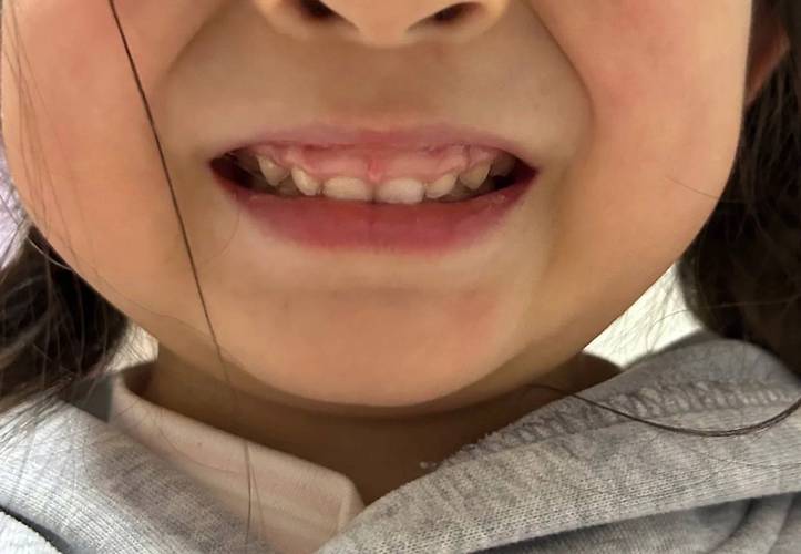 牙齿矫正后牙龈突出是什么原因导致的？-图1