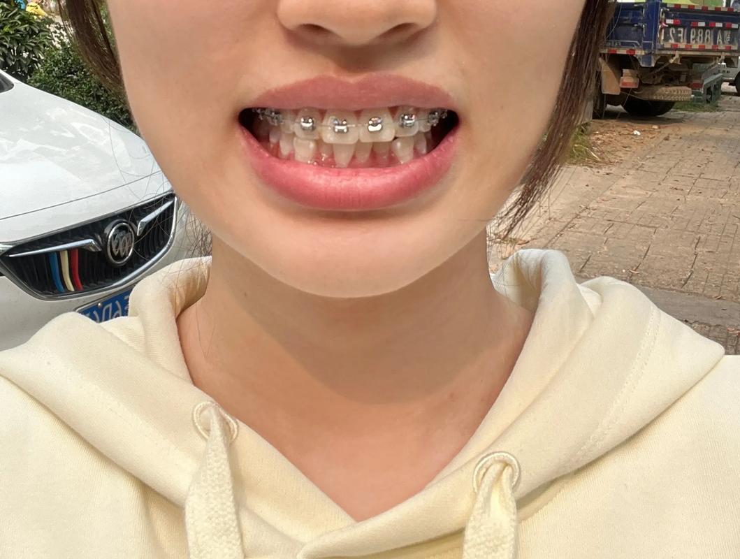 牙齿矫正后牙龈突出是什么原因导致的？-图2