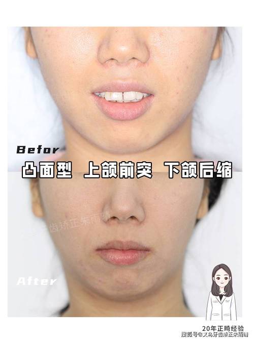 牙齿矫正下巴后缩短-图2