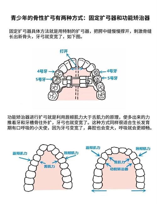 扩弓矫正牙齿的好处-图2
