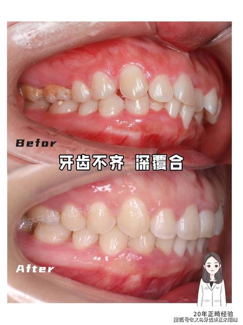 很不整齐的牙齿矫正-图3