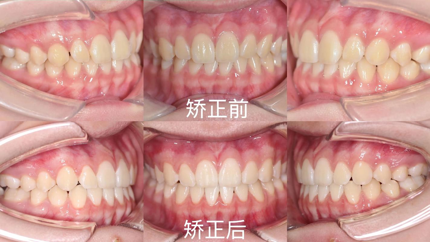 很不整齐的牙齿矫正-图2