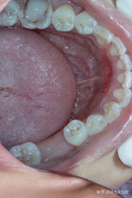 矫正牙齿后抽烟会影响矫正效果吗？-图3