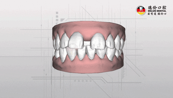 矫正牙齿过程动态图-图1