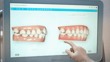 矫正牙齿过程动态图-图2