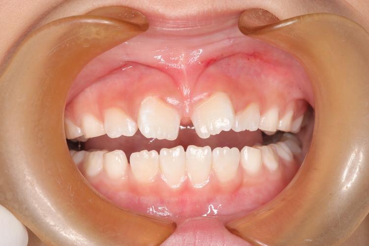 儿童牙齿矫正真的会痛吗？-图1