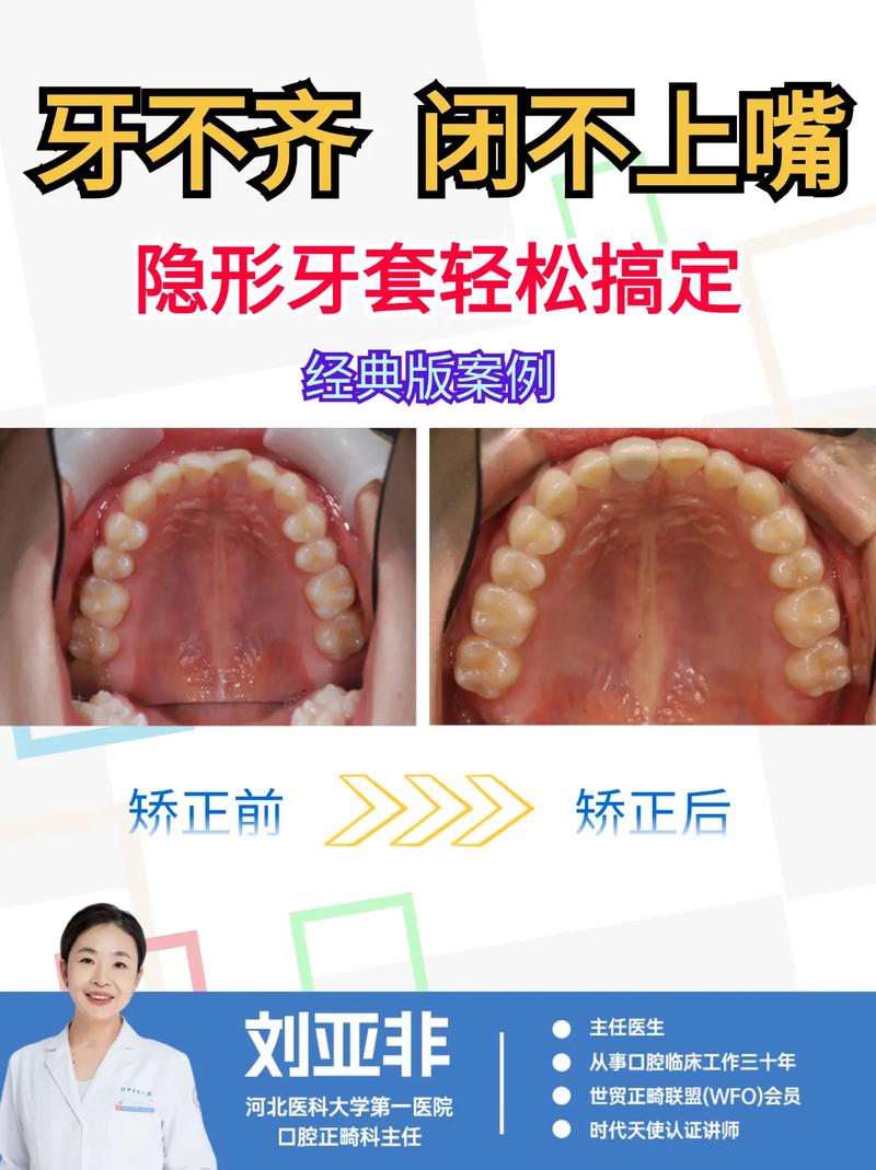 隐形牙齿矫正去哪里-图1