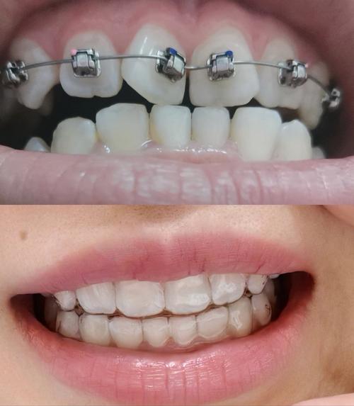 矫正后门牙反而外凸是为什么？-图1