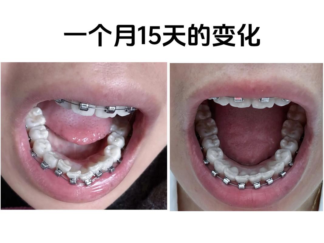 成年后矫正牙齿还来得及吗？效果会打折扣吗？-图2