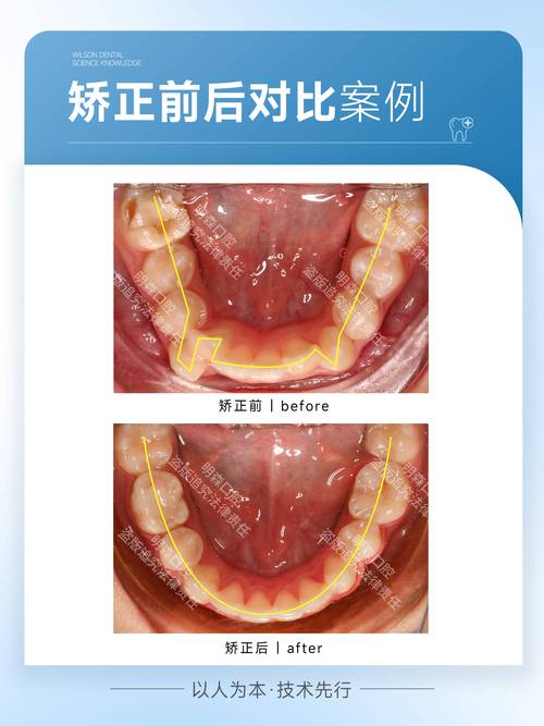 南山矫正牙齿哪家好？这几家医院靠谱吗？怎么选才合适？-图2