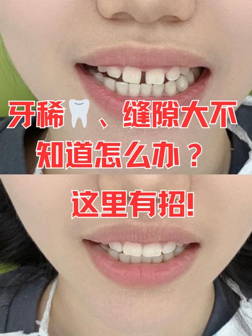 牙齿稀疏矫正有哪些方法？不同情况如何选择合适方案？-图3