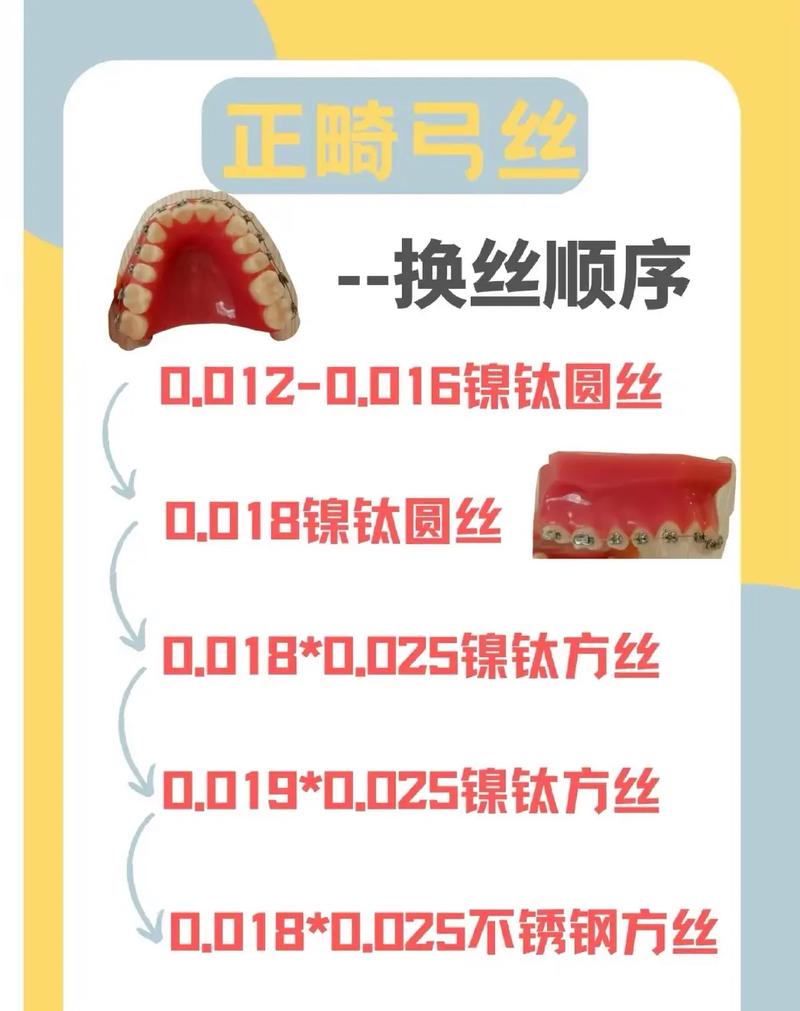 牙齿矫正多久更换一次钢丝？-图1