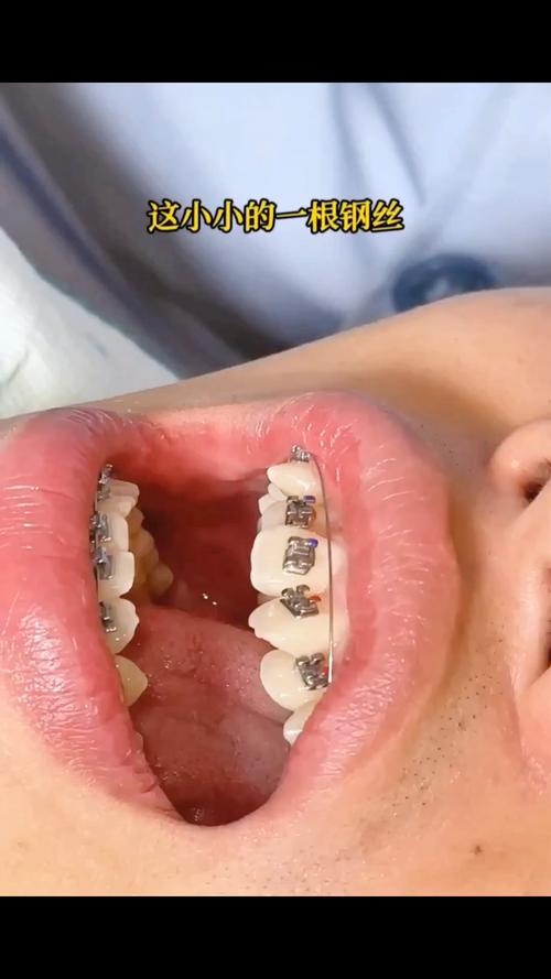 牙齿矫正多久更换一次钢丝？-图3