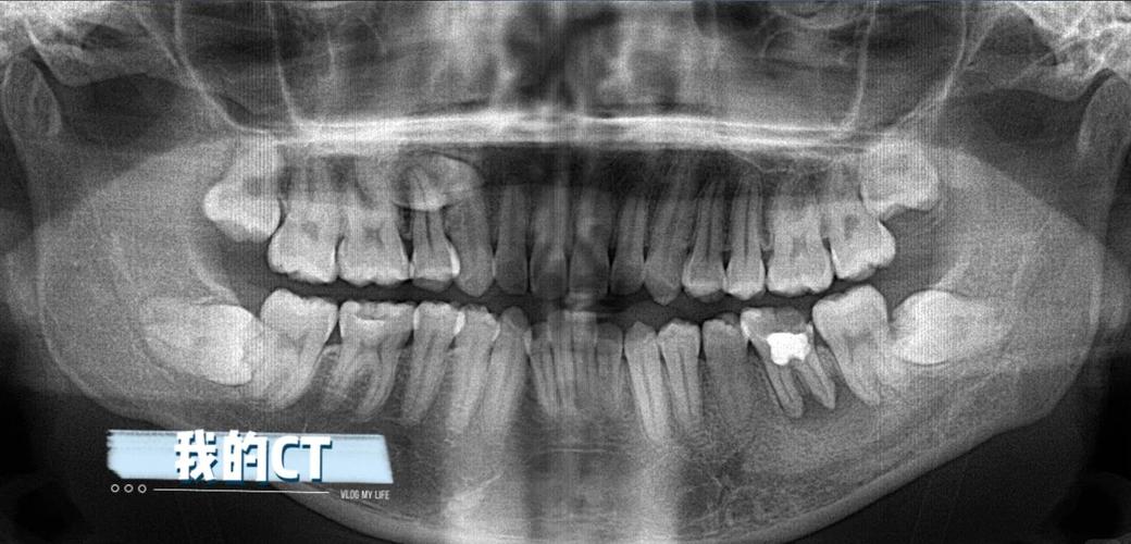 矫正牙齿拍什么片子-图2