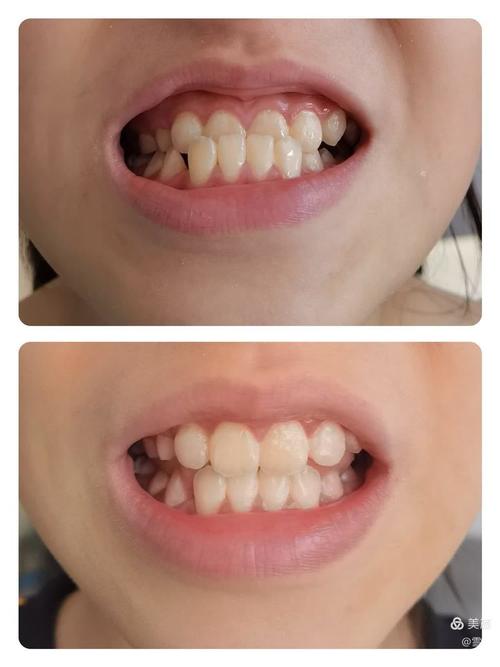 小孩牙齿矫正的图片-图2