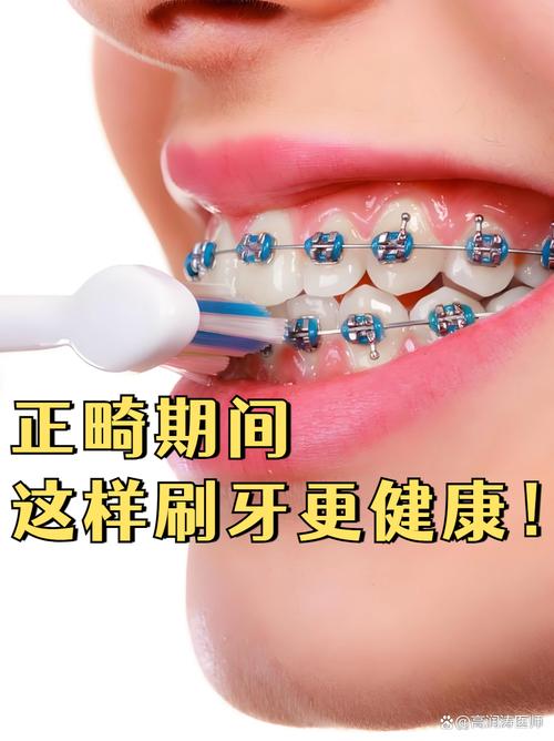 矫正戴牙套后，怎样刷牙才能清洁到位又不伤牙套？-图2