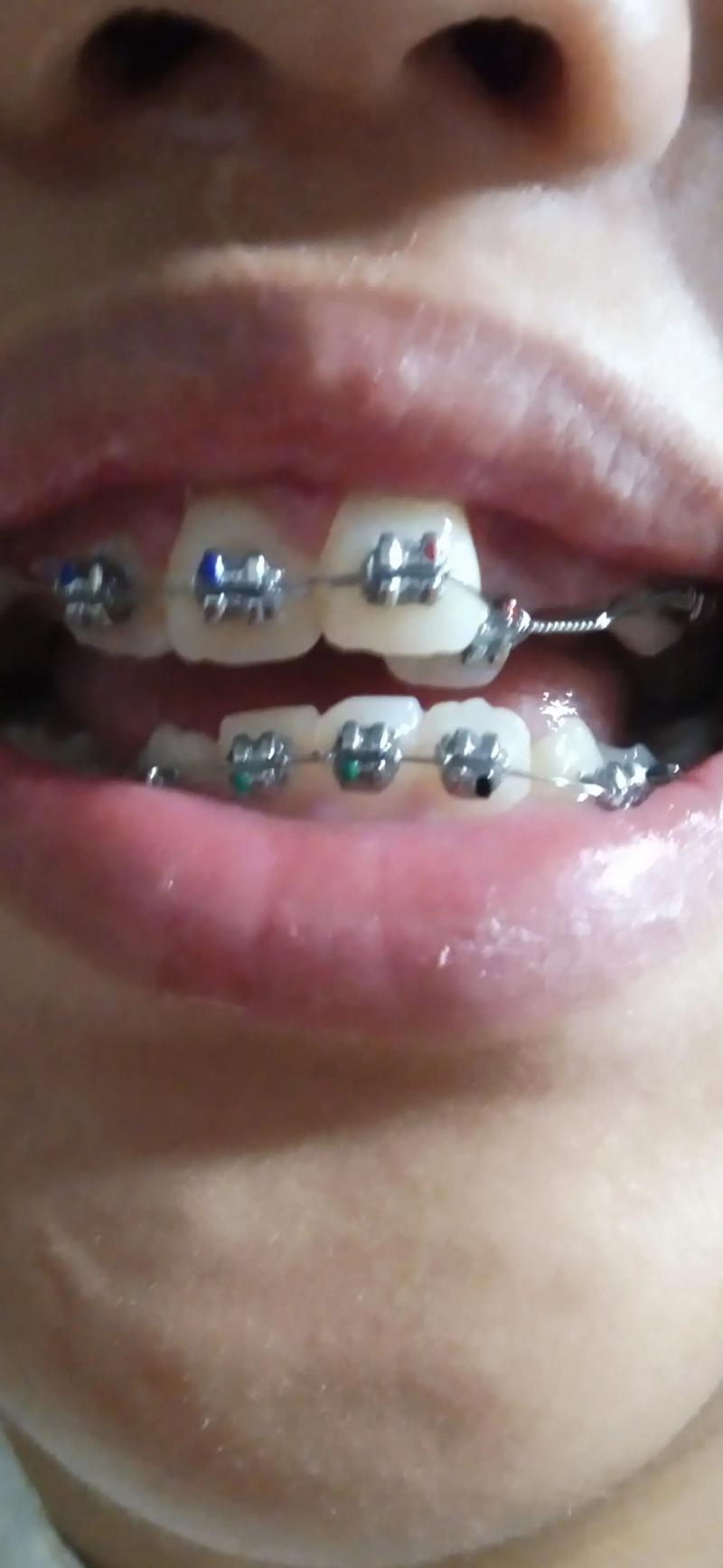 矫正牙齿的记忆钢丝-图2